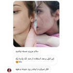 ضدلک لونا