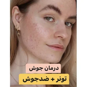 پکیج درمان جوش