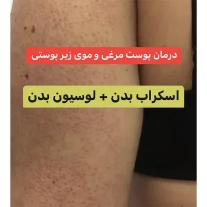 پکیج درمان پوست مرغی و موی زیر پوستی