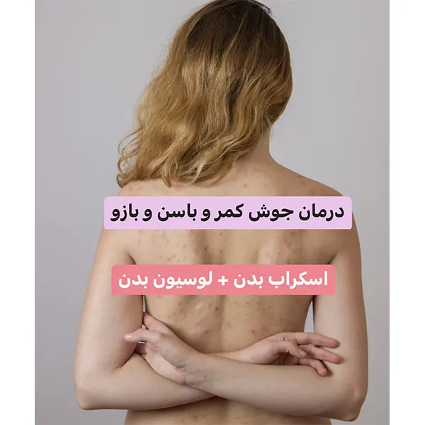 پکیج درمان چوش کمر و باسن و بازو پکیج درمان چوش کمر و باسن و بازو